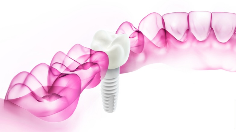 Keramikimplantate & Zirkonimplantate in Neuss-Grimlinghausen