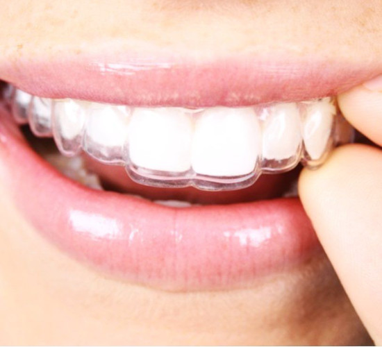 Unsichtbare Zahnspangen werden für Sie von der Zahnarztpraxis in Düsseldorf erstellt